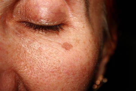 Uneven or Sun Damaged Skin