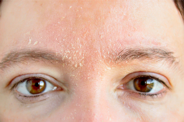 Extremely Dry Skin, Itchy, Flaky & Rough